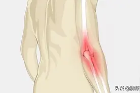 炎症在骨关节炎中起到了什么作用图片