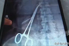 腹中15公分止血钳折磨产妇一年多终被取出，究竟谁才是它的主人？图片