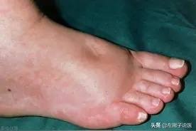 下肢出现水肿，是水喝多了还是肾脏出现问题了？本文告诉您真相图片