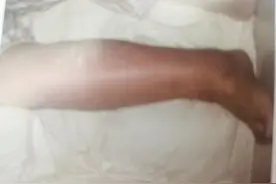 一条腿小腿和脚红肿疼痛是什么病 丹毒的表现与治疗图片