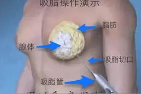 小伙乳房发育减肥也减不掉！ 哈医大一院乳腺外科无痕手术解决男性乳房发育困扰图片