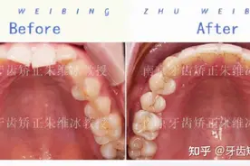南京牙齿矫正｜前牙严重扭转，利用隐适美轻力优势规避骨开窗风险图片