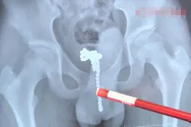 整整68颗！13岁男孩体内塞进磁力珠，疼痛难忍才告诉家长图片