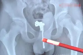 整整68颗！13岁男孩体内塞进磁力珠，疼痛难忍才告诉家长图片