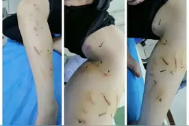 不忍直视！德州一男孩被猫袭击，伤口40余处！看好停课在家的熊孩子图片