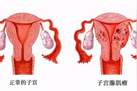 子宫腺肌症：“不死的癌症”也能够治愈图片