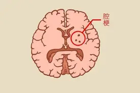 发现腔梗，就要吃阿司匹林吗？医生提醒：做到这5件事更重要图片