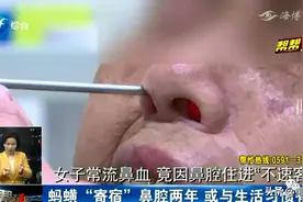 女子莫名频繁流鼻血，打了一个喷嚏后，把自己和医生都吓了一跳图片