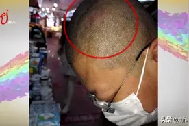 走路撞上路边牌匾，头部撞出血肿！这样的牌匾你身边有吗？图片