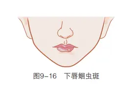 「观面无隐私」 下嘴唇警示：可能是多种癌症图片