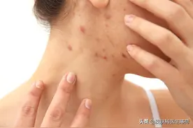 皮肤科医生教你如何处理痘印图片