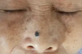 What？这不是“痣”，是皮肤癌！图片