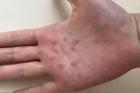 伪装者——梅毒图片