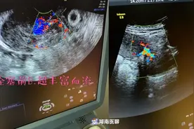 疤痕妊娠术中大出血怎么办？“介入”阻断血流，实现“无血手术”图片