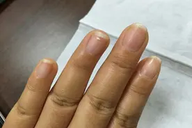 指甲上长竖纹，越长越多，和什么原因有关？图片