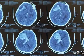 【险中急救】一场生死时速的竞赛：10岁女孩突发脑出血，紧急手术妙手“排雷”！图片