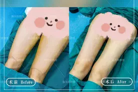 大腿环吸后，大腿根部皮肤凹凸不平是怎样回事？图片