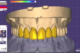 绚彩3D前牙全形态冠设计五步法图片