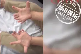 4岁女童有27个手指脚趾，妈妈：一出生就这样图片