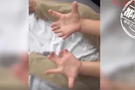 4岁女童有27个手指脚趾，妈妈：一出生就这样图片