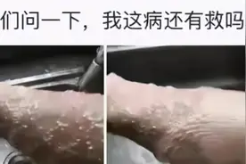 “一沾水就犯病！我这是怎么了？”不要可以卸掉，哈哈哈图片