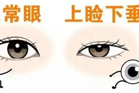 睡眼惺忪的你是不是早已患上了上睑下垂？图片