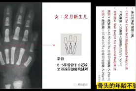 每日影像，#女性骨龄(15岁以内)一览图。实际年龄和骨龄会有差距视频封面