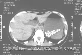 珍珠奶茶中的珍珠究竟会不会造成肠梗阻呢？视频封面