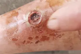 肌肉腐烂。伤口感染。不用怕。