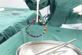 危险！一岁女童吞了36颗磁力珠 在肚子里穿成了一个串视频封面