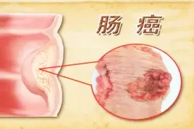 大便出现金黄是肠癌吗？医生建议这样做！
