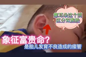 双胞胎靠耳朵这个洞来区分，不是象征富贵命而是胎儿发育不良瘘管