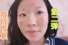 Amy痘坑恢复2-co2点阵激光痘坑回复第三天视频封面