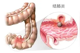 一旦出现这几种表现，一般就是结肠炎的症状，医生建议这样治疗视频封面