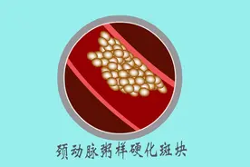 经常感觉头晕恶心、昏昏沉沉，可能是颈动脉硬化已经很严重了！视频封面
