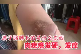 12岁孩子胳膊肘，长了一些肉疙瘩发硬，发痒，一定要看医生才放心视频封面