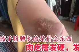 12岁孩子胳膊肘，长了一些肉疙瘩发硬，发痒，一定要看医生才放心视频封面