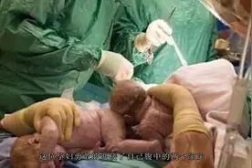 孕妇亲自接生腹中双胞胎，全场医护保驾护航，生命就是如此伟大视频封面