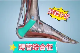 解剖分析引起足部疼痛、麻木的“踝管综合征”，最容易被误诊视频封面