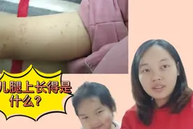 女儿腿上长了很多跟水痘一样的东西，是什么？该怎么护理？视频封面