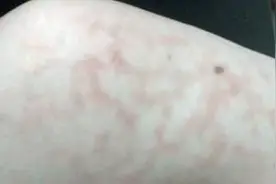 冬天天气冷，经常骑火上烤火，时间久了大腿内侧烤黑了。视频封面