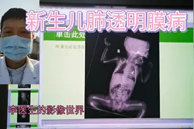 新生儿肺透明膜病视频封面