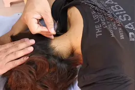 针灸临床日志：长期低头斜方肌容易劳损，脖子疼痛怎么办？视频封面