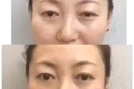 什么是泪沟?
内眼角开始在下眼睑靠鼻侧一条凹沟
特别显老的重视频封面
