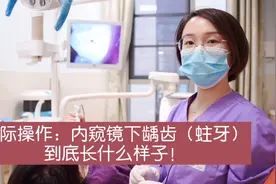 真实操作看看内窥镜下蛀牙到底长什么样？视频封面