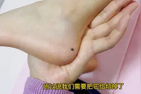 马芽芽脚跟上长了一颗痣，需要去医院切掉。大家不要小看身上的痣视频封面