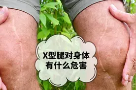 X型腿对身体的这些危害，十有九人不清楚，看看你知道吗？视频封面