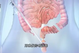 直肠癌手术没切口?不是天方夜谭-请看3D腹腔镜直肠癌NOSE手术视频封面