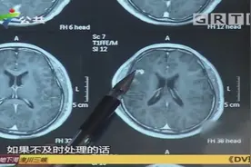 少年癫痫发作，医生发现他脑中有条7cm的裂头蚴，存活了6年视频封面