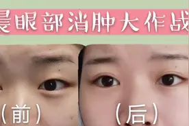 早晨眼睛消肿怎么做又快又有效？一起见证消肿全过程视频封面